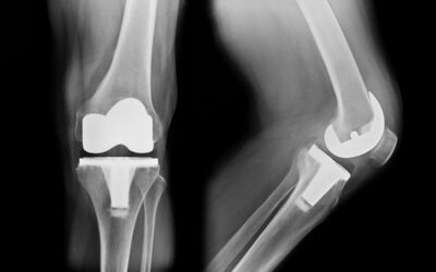 Use of Prescription Opioids to Manage Acute Pain after Orthopedic Surgery
